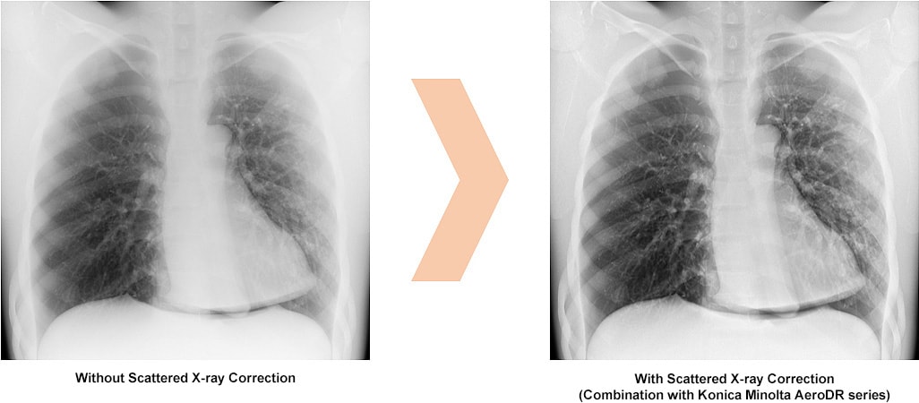 Scatter Correction Enables Grid-less Radiography 