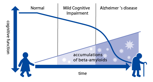 Hypothesis about progression Alzheimer's disease
