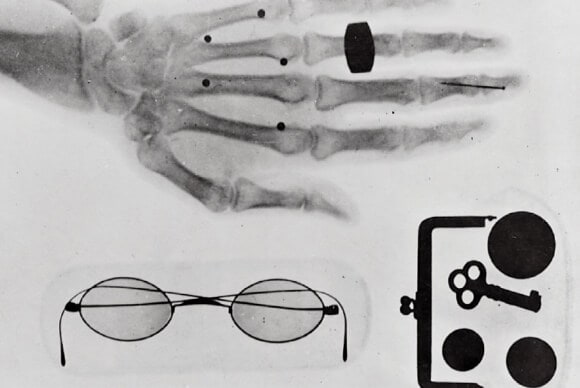 Early X-ray photograph